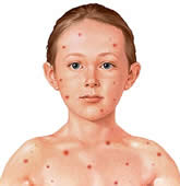 Rimedi naturali per la varicella