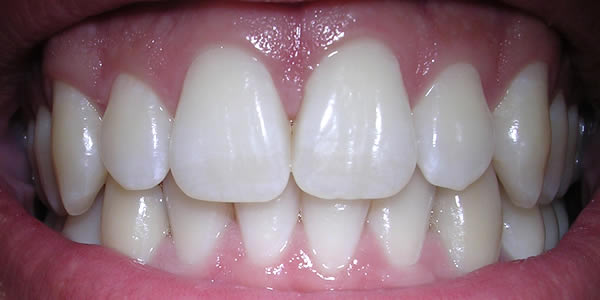 3 metodi naturali sbiancare denti