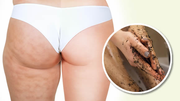 rimedi naturali per cellulite