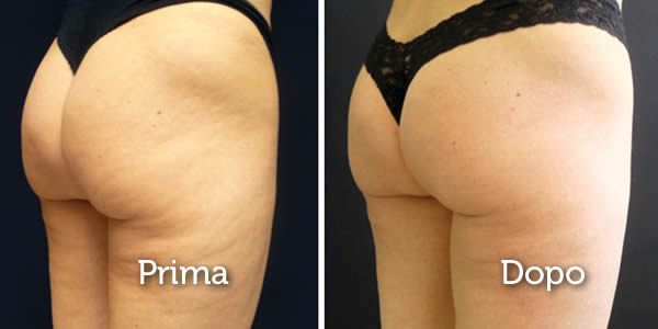 rimedi per cellulite