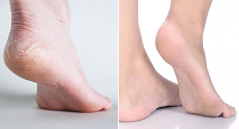 callosités pieds bicarbonate