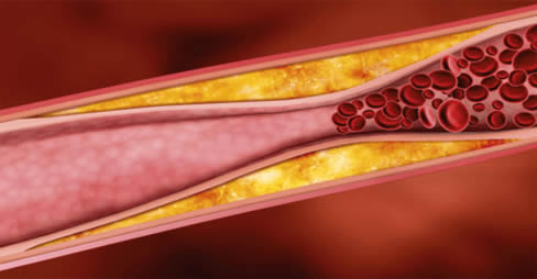 rimedio prevenire infarto