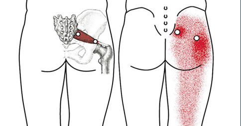 rimedi naturali sciatica