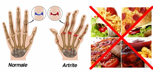 alimenti artrite