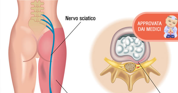 alleviare dolore sciatico