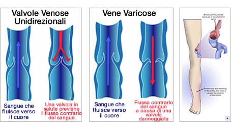 prodotti naturali per combattere le vene varicose