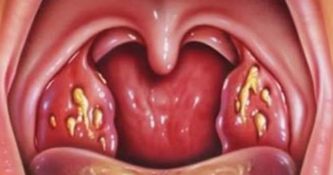 rimedi calcoli tonsillari