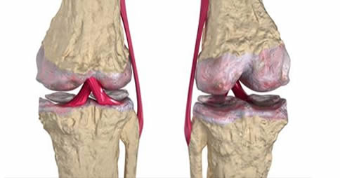 rimedio osteoartrite