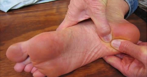 sperone calcaneare