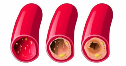 sbloccare arterie intasate rimedio