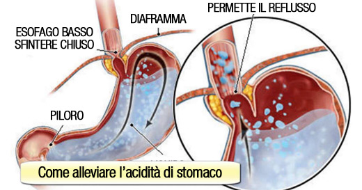 acidita-stomaco