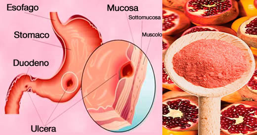 ulcere dello stomaco