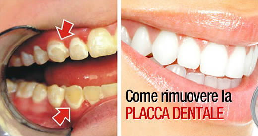 come rimuovere placca dentale