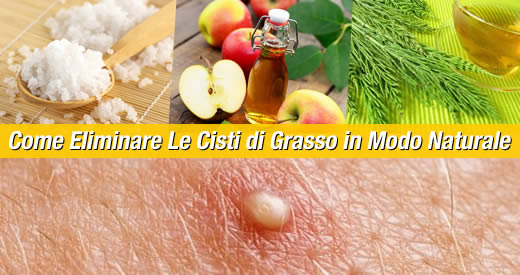 come eliminare le cisti di grasso