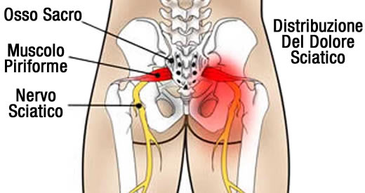 3 rimedi naturali sciatica