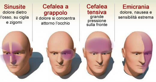 4 tipi di mal di testa
