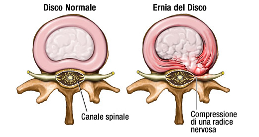 ernia del disco come alleviare