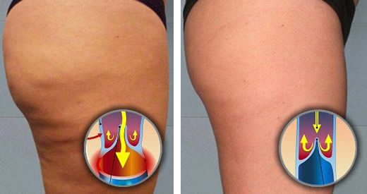 riattivare circolazione cellulite