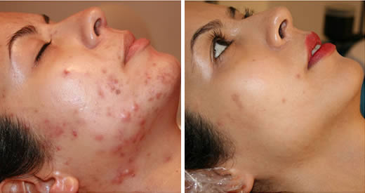 3 rimedi naturali acne