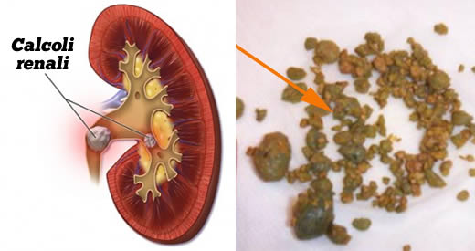 rimedio espellere calcoli renali