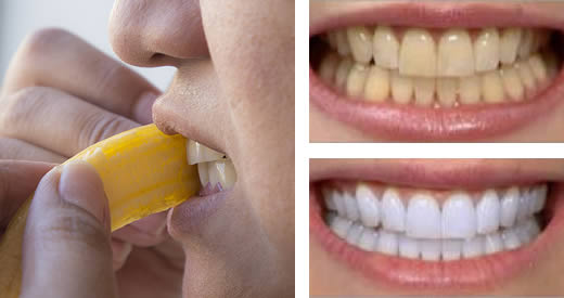 sbiancare denti banana