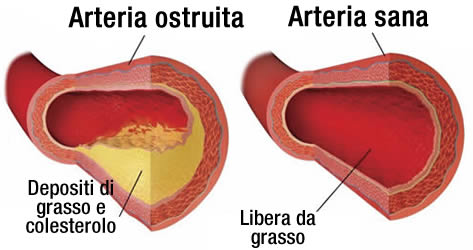 sbloccare arterie