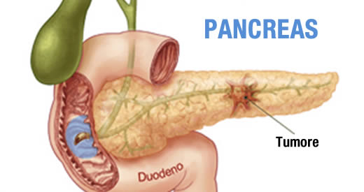 tumore al pancreas