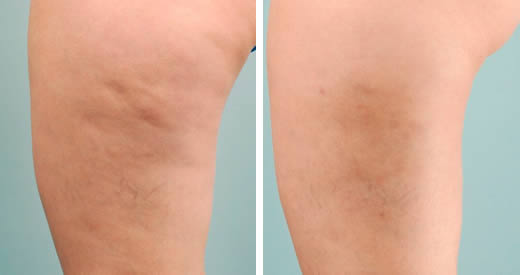 4 rimedi cellulite