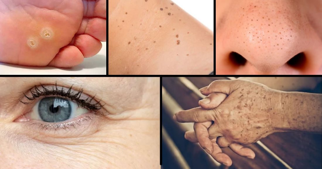 Come eliminare verruche, punti neri, macchie e rughe in modo naturale