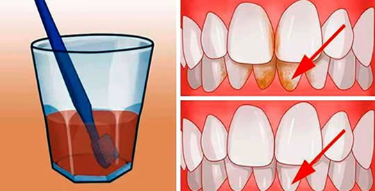 sbiancare i denti