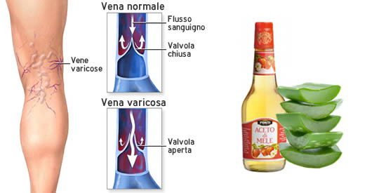 aloe vera per vene varicose