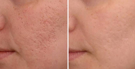 cicatrici acne rimedi