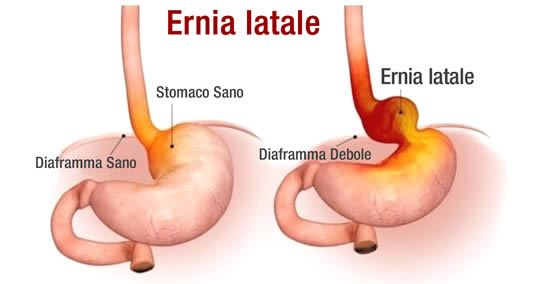 Ernia Iatale Tutti I Sintomi E Come Alleviarli In Modo Naturale