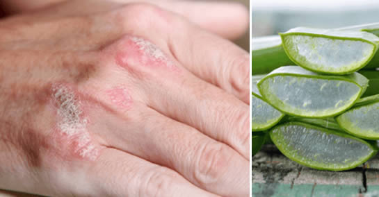 aloe vera per psoriasi