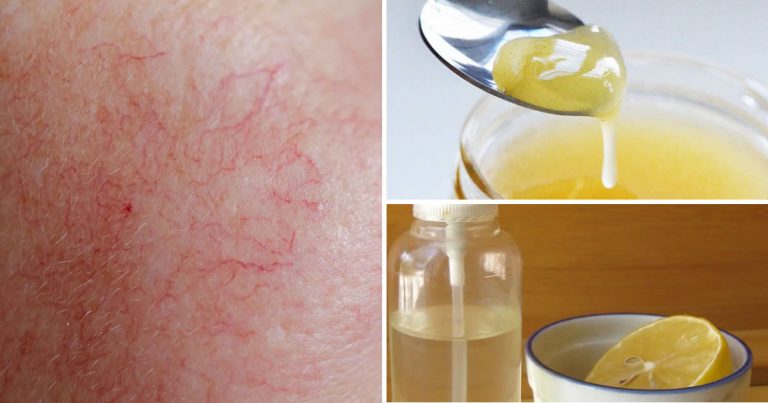 Capillari Rotti Su Viso E Gambe 2 Metodi Efficaci Per Eliminarli